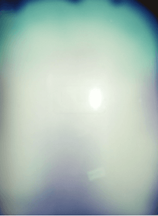 Aura en thérapie